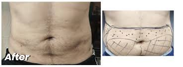 You are currently viewing Liposuction in Islamabad, Pakistan: Cost, Procedure & What You Need to Know