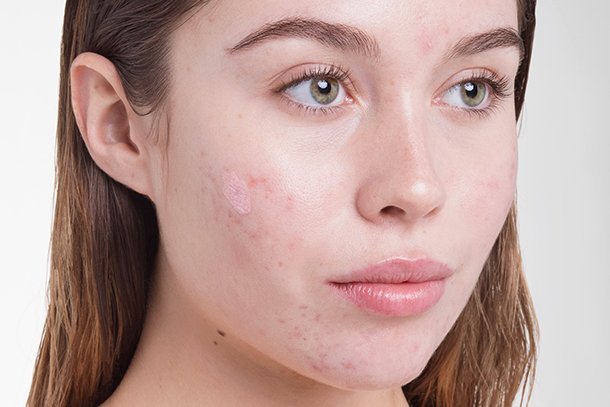 You are currently viewing How Stress Affects Your Skin