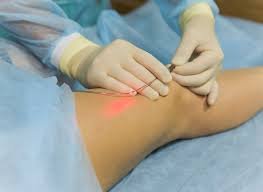 Read more about the article Laser Treatment for Varicose Veins: A Modern Solution for Pain-Free Recovery