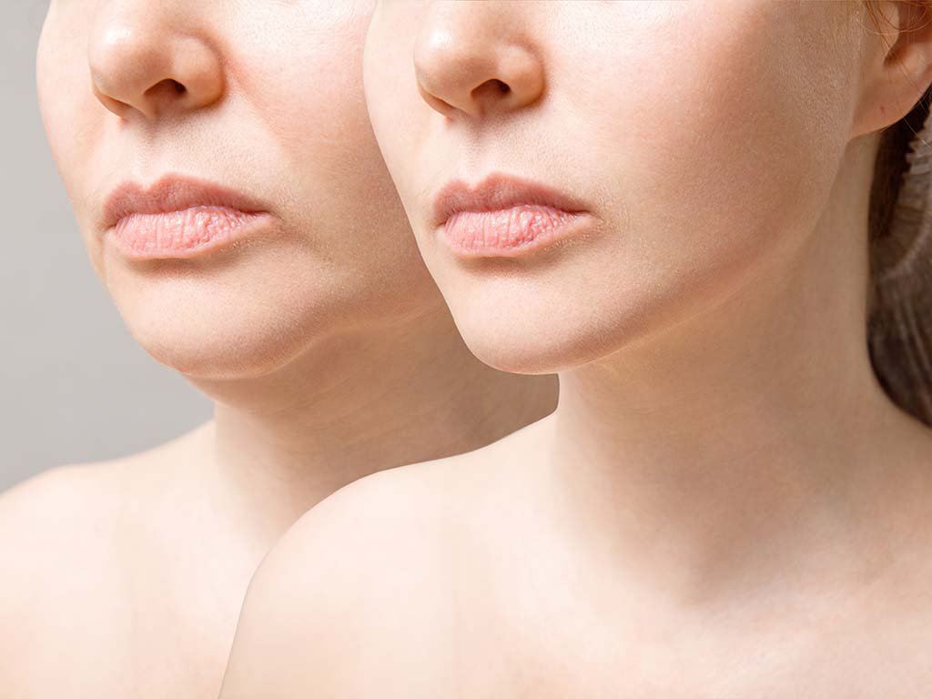 You are currently viewing Top Reasons to Choose Morpheus8 for Non-Surgical Skin Tightening