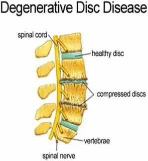 Read more about the article Degenerative Joint Disease ICD 10 Code: A Complete Guide for Patients and Professionals