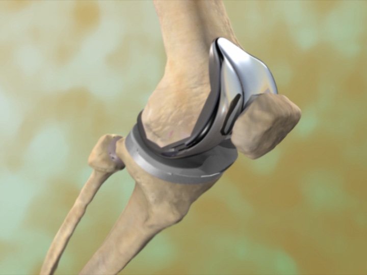 Read more about the article How to Choose the Best Knee Replacement Surgeon in Jaipur: A Complete Guide