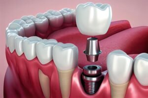 Read more about the article A Complete Guide to All-on-4 Dental Implants