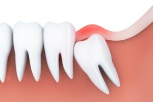 Read more about the article When should wisdom teeth be removed?