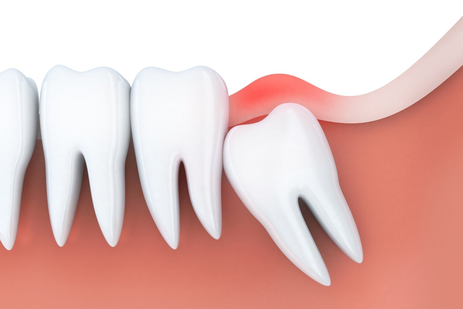 Read more about the article When should wisdom teeth be removed?