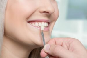 Read more about the article How long does composite dental bonding last?