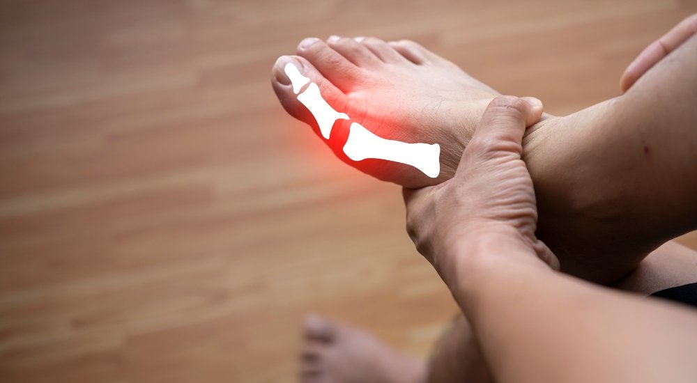 You are currently viewing What Are the Top 7 Medications Commonly Used in Gout Treatment