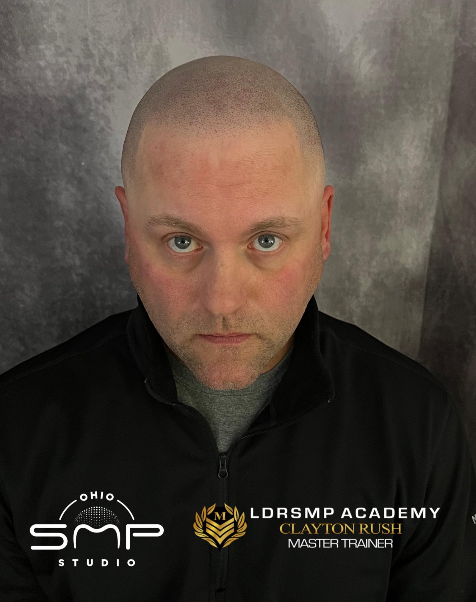 Read more about the article Experience a Transformation with Scalp Micropigmentation in Painesville, Ohio