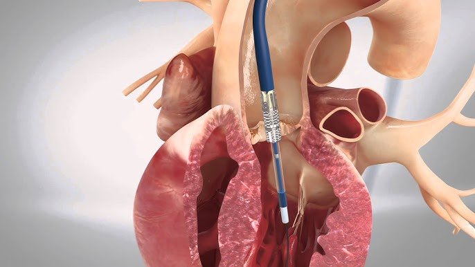Read more about the article Meet the Leading TAVI Specialists in Jaipur for Advanced Heart Valve Care