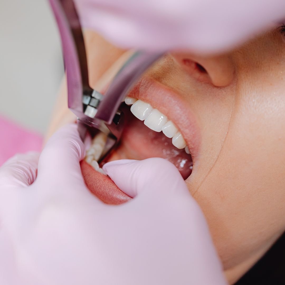You are currently viewing Gum Care : 5 Expert Tips for Prevention of Gum Disease