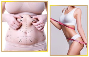 Read more about the article Preparing for Liposuction in Islamabad: Step-by-Step Guide
