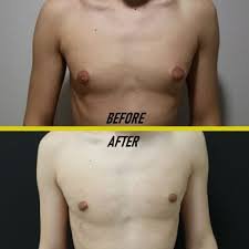 You are currently viewing Gynecomastia Surgery Before and After: How Surgery Changes Your Chest