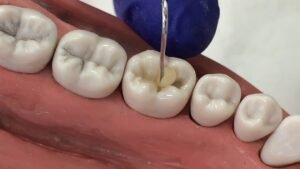 Read more about the article What is the Average Cost of a Resin Filling?