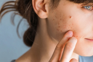Read more about the article How Acne Treatment Benefits Men and Women Equally?