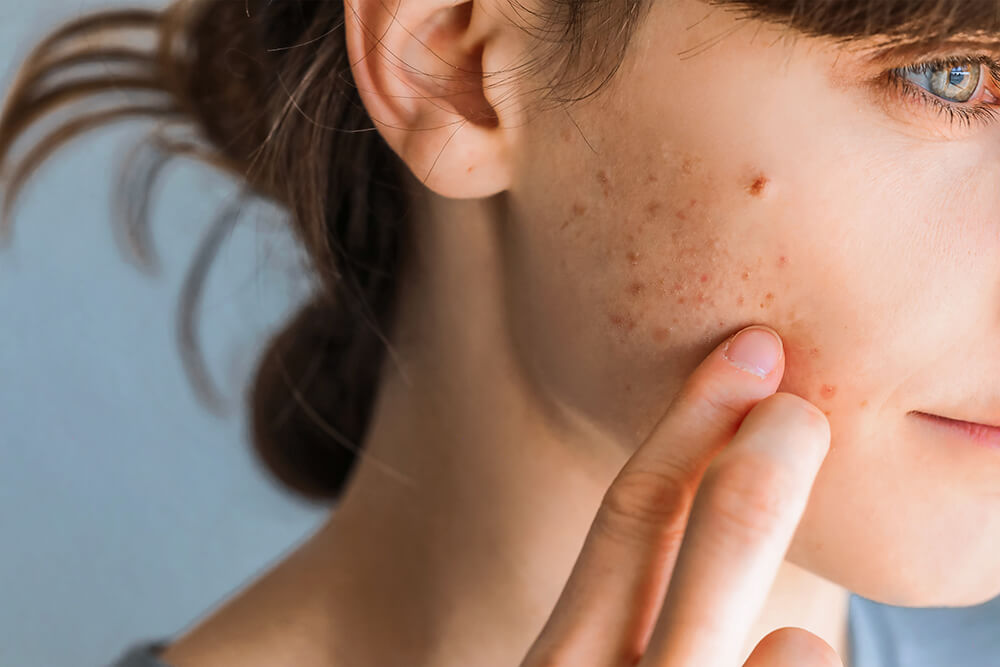 Read more about the article How Acne Treatment Benefits Men and Women Equally?