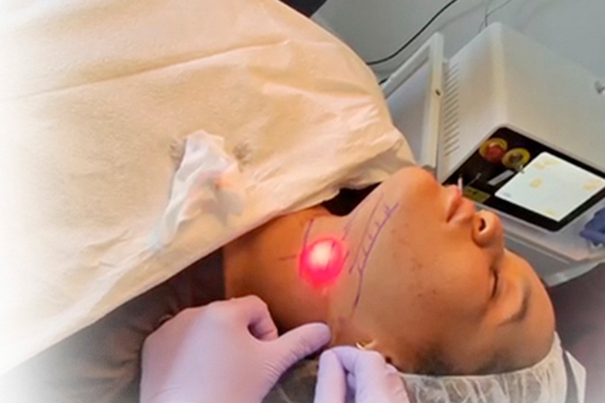 Read more about the article How Does Endolift Stimulate Collagen Production?