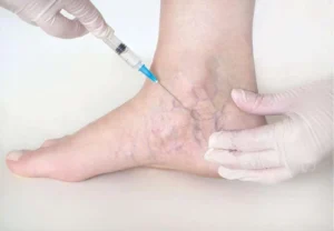 Read more about the article Early Diagnosis and Deep Vein Thrombosis Treatment in Jaipur: Why It Matters