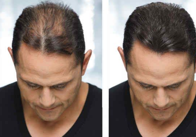 Read more about the article Restoring Confidence with Hair Transplant Cost in Dubai: A Complete Guide to Value and Expertise