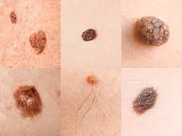 Read more about the article Importance of Regular Skin Checks for Early Skin Cancer Detection