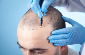 Read more about the article Robotic Hair Transplants: Are They Worth the Hype?