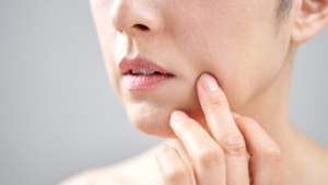 Read more about the article How Belotero Fillers Fix Lip Lines and Creases
