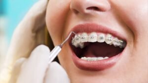 Read more about the article How Dental Braces Correct Jaw Misalignment