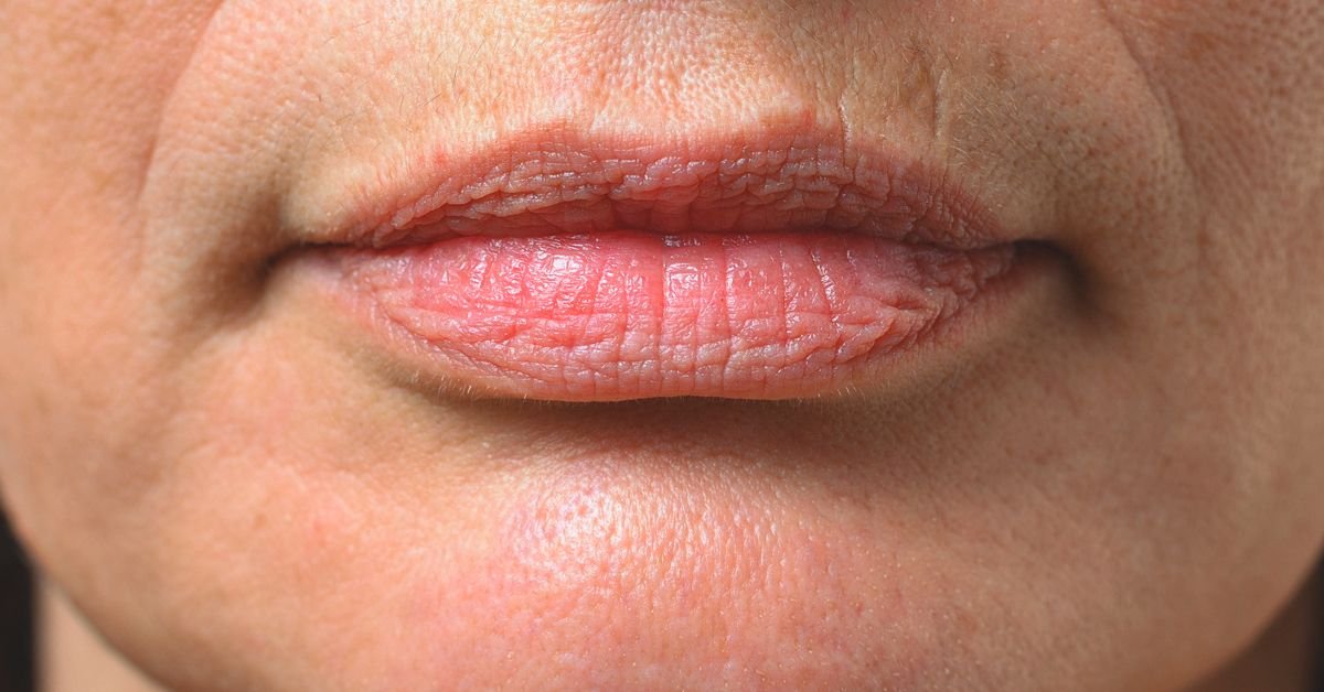 Read more about the article How Smoker’s Lips Treatment Corrects Heavy Pigment
