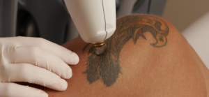 Read more about the article Is Tattoo Removal Abu Dhabi Suitable for Dark Skin?