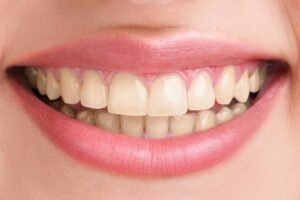 Read more about the article What Causes the Need for Frequent Teeth Whitening