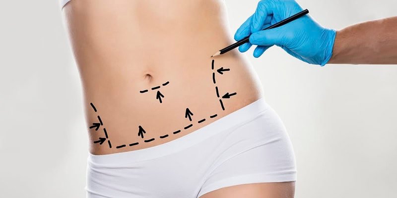 Read more about the article Minimally Invasive Liposuction Techniques You Should Know About