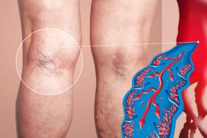 Read more about the article Varicose Veins Treatment Options Explained by a Leading Varicose Veins Specialist in Jaipur