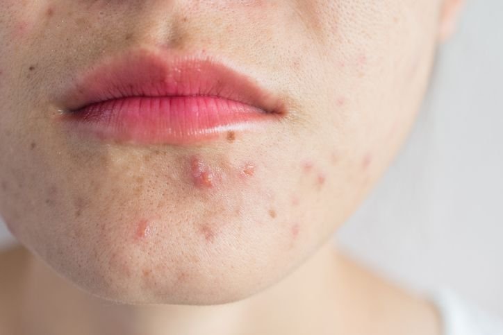 You are currently viewing Acne Treatment Focused on Skin Health