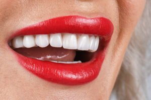 Read more about the article Are E-Max Veneers Worth It for Uneven Tooth Shapes?