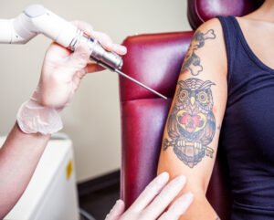 Read more about the article Effective Tattoo Removal for All Skin Types