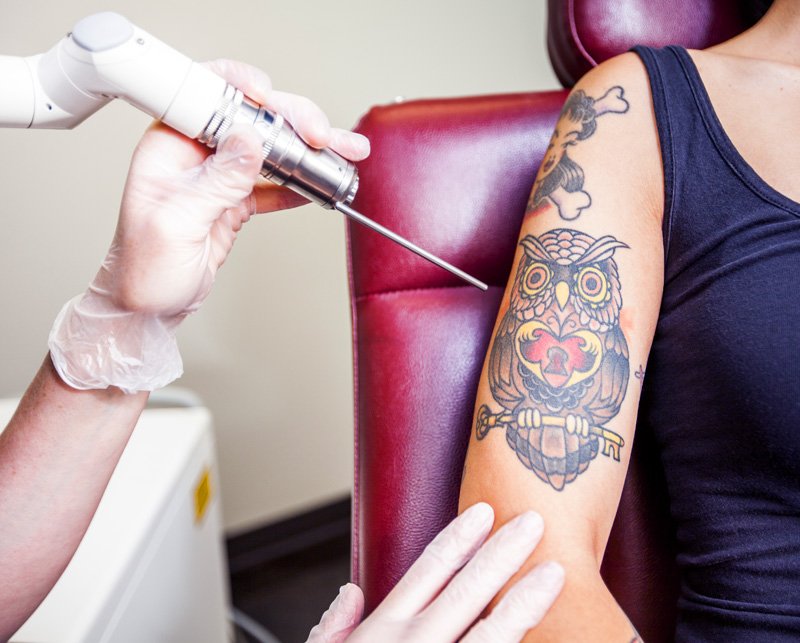 Read more about the article Effective Tattoo Removal for All Skin Types