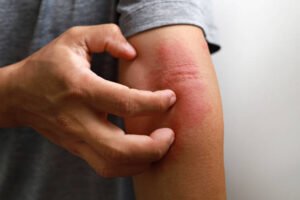 Read more about the article How Eczema Treatment Helps Reduce Nighttime Itching ?