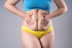 Read more about the article How Endoscopic Sleeve Gastroplasty Supports Weight Plateaus ?