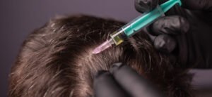 Read more about the article How Exosome Therapy for Hair Loss Repairs Follicles