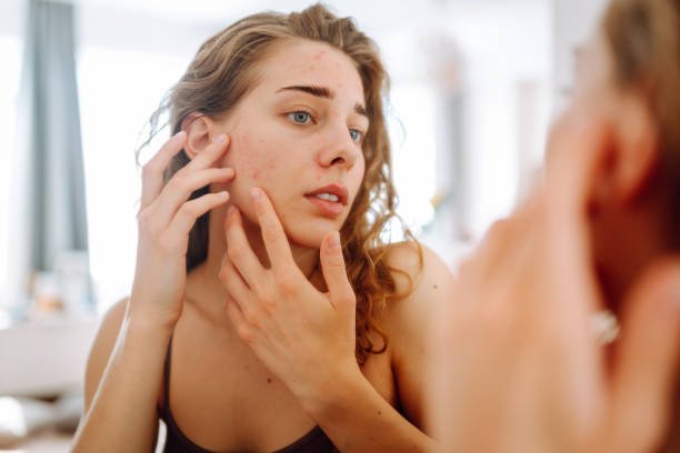 Read more about the article Is Laser Acne Scar Treatment Safe for All Skin Types?