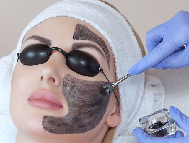 Read more about the article Laser Carbon Peel for Youthful and Revitalized Skin