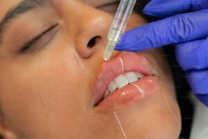 Read more about the article Lip Filler Tailored to Your Facial Features