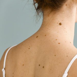 Read more about the article Are Skin Tags Contagious? Top Questions People Ask About Skin Tags