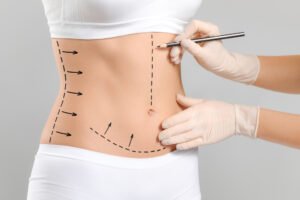 Read more about the article Mini Abdominoplasty for Defined Waistline Results