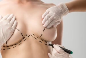 Read more about the article Modern Techniques for Breast Lift Surgery