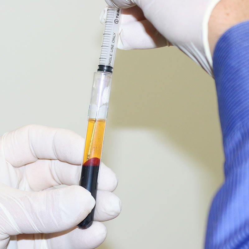 Read more about the article Pain-Free Knees with Professional PRP Injections