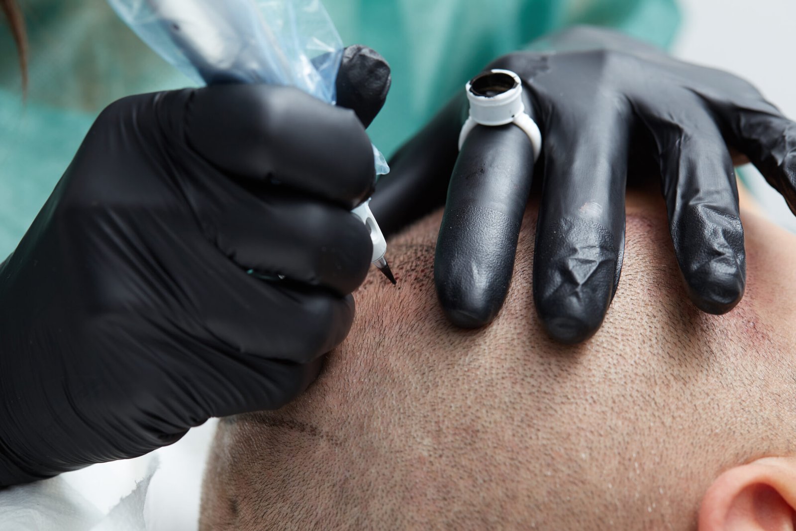 Read more about the article Scalp Micropigmentation with Long-Lasting Results