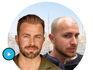 Read more about the article Transform Your Look: Turkey Clinic Hair Transplant