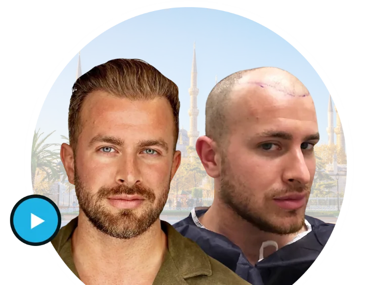 Read more about the article Transform Your Look: Turkey Clinic Hair Transplant