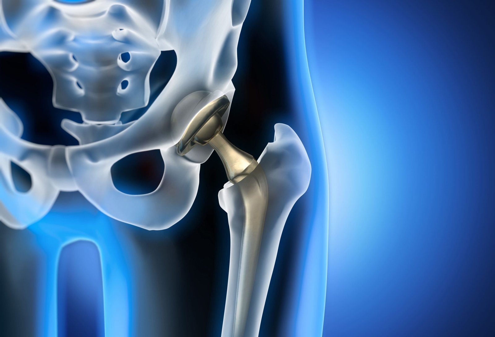 You are currently viewing Longevity of Hip Replacements: Complete Lifespan Guide