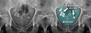 Read more about the article Bladder Stones: Causes, Symptoms, and Effective Treatment Options